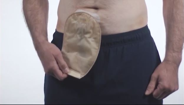 a man with an ostomy pouch