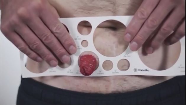 a man measuring an ostomy