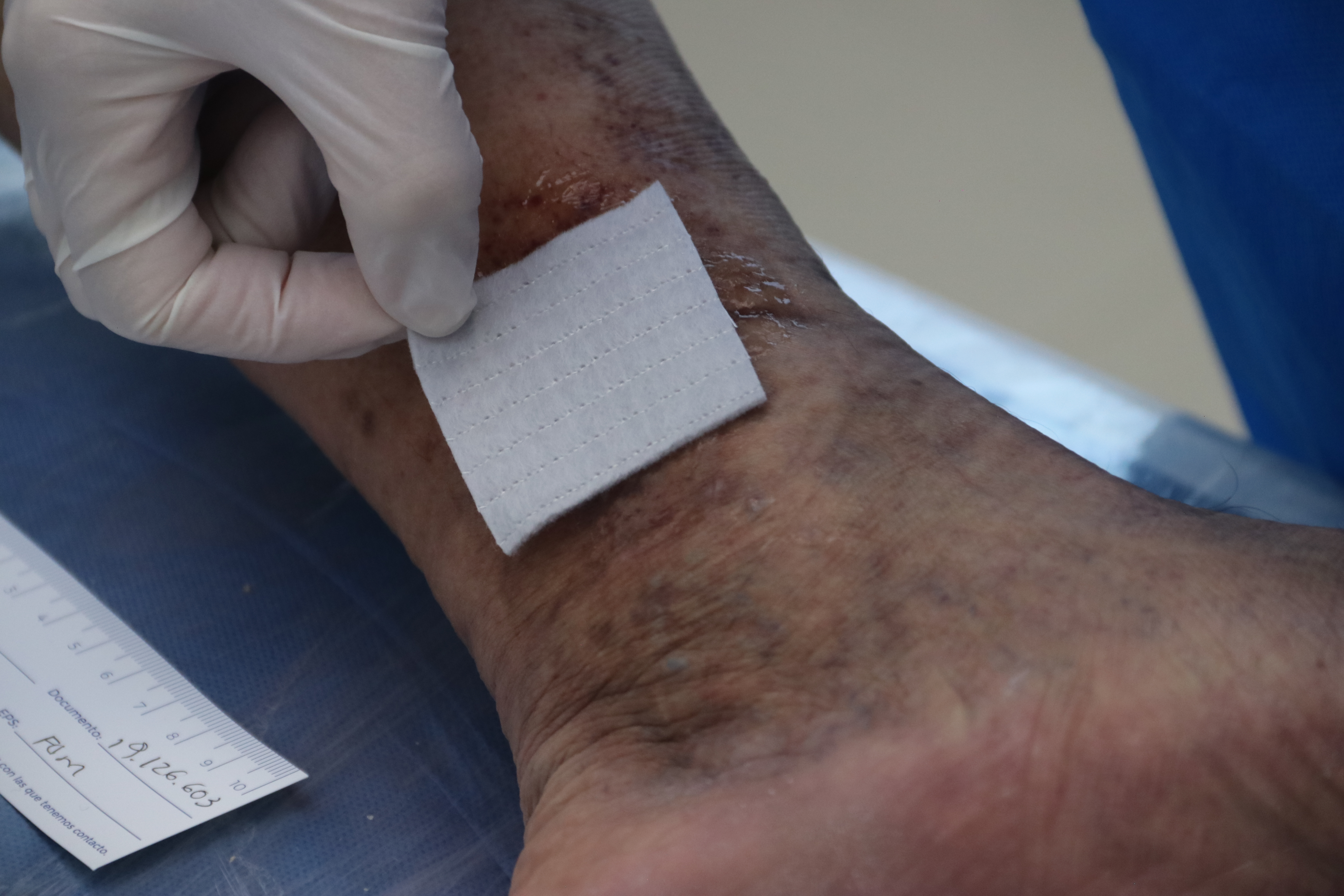 wound dressing on a wound