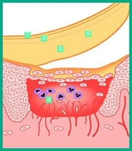 en tegning af, hvordan DuoDERM® Dressings fungerer