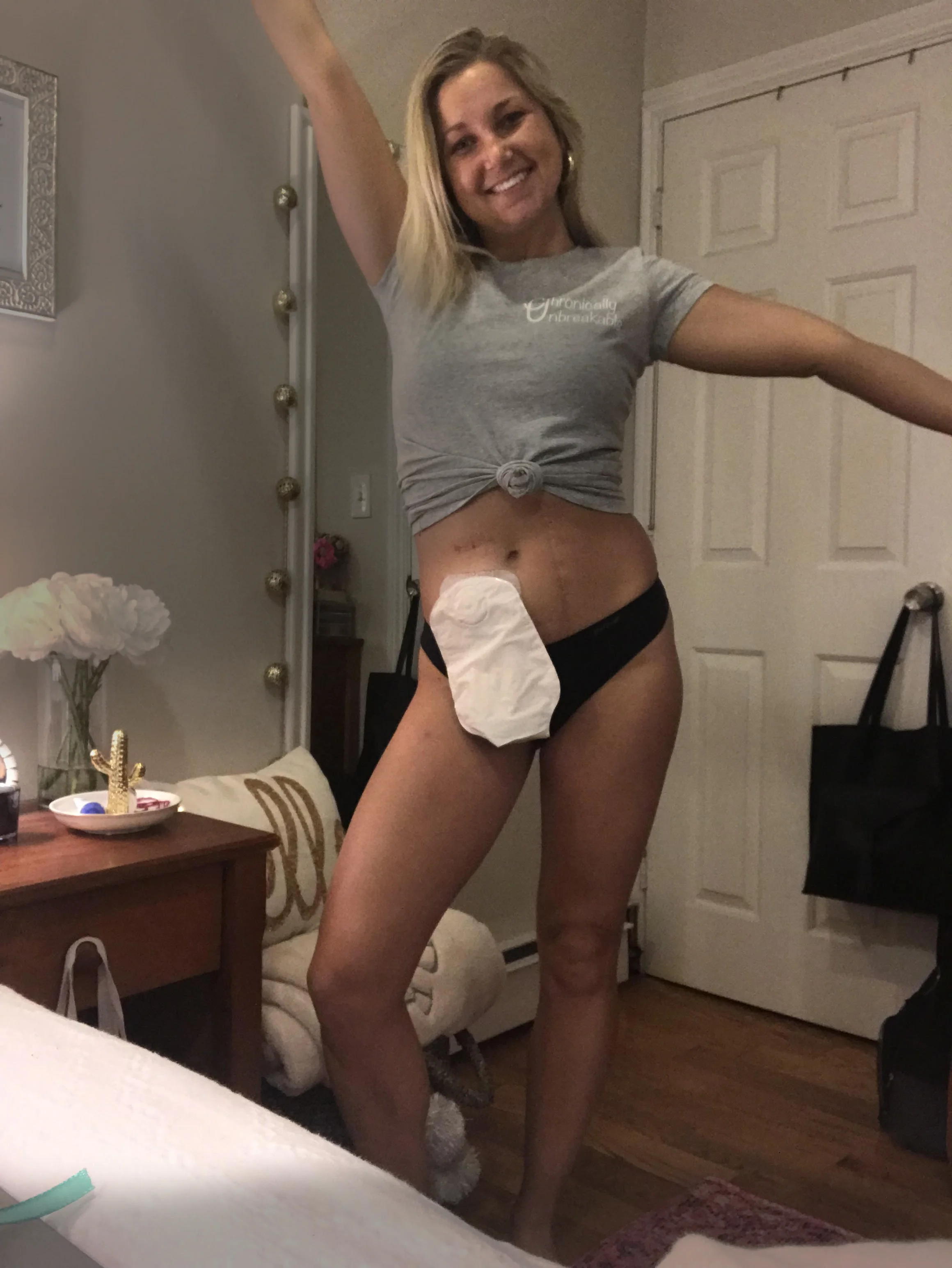 woman wearing ostomy pouch 
