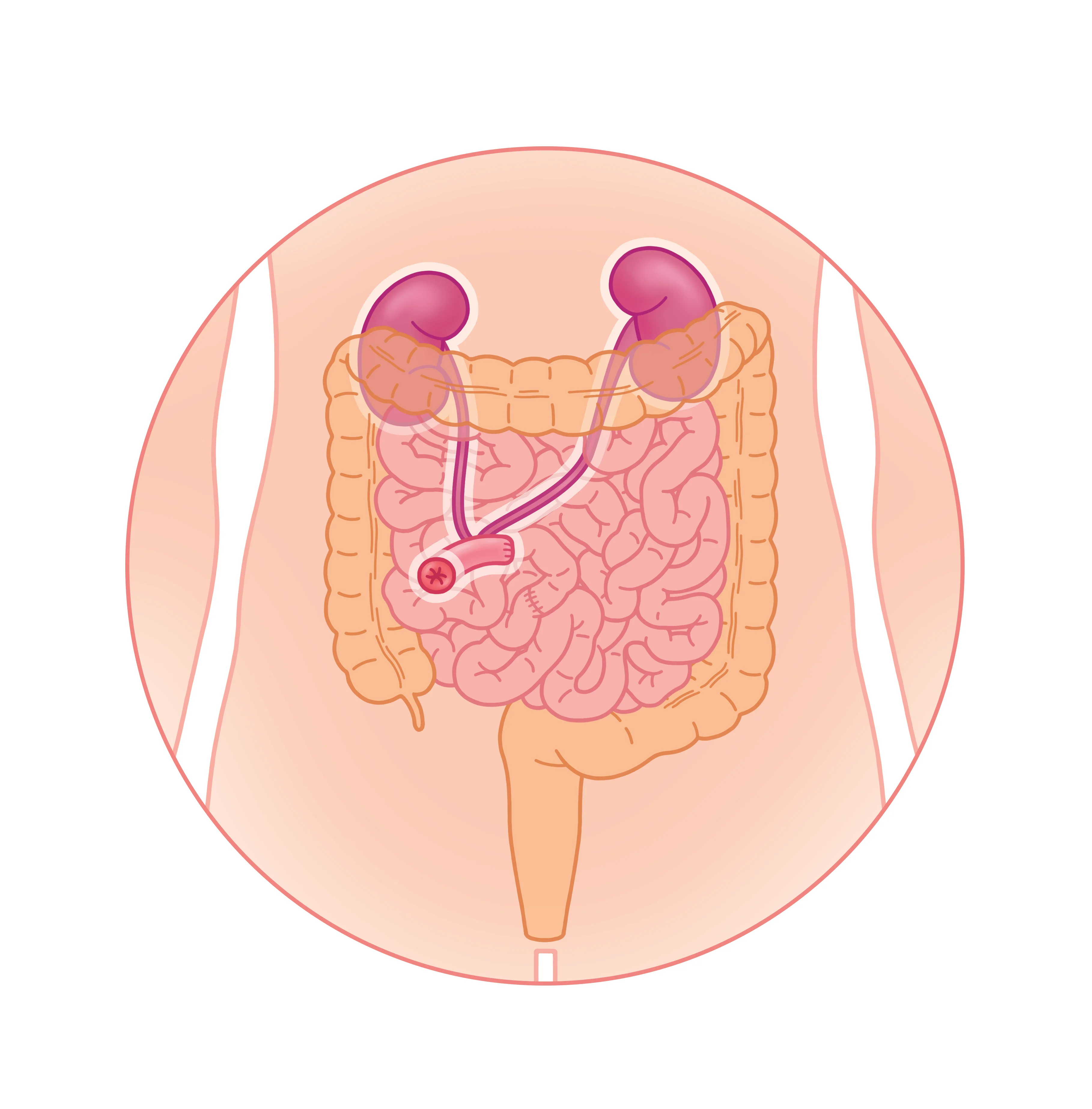 Ureterostomie