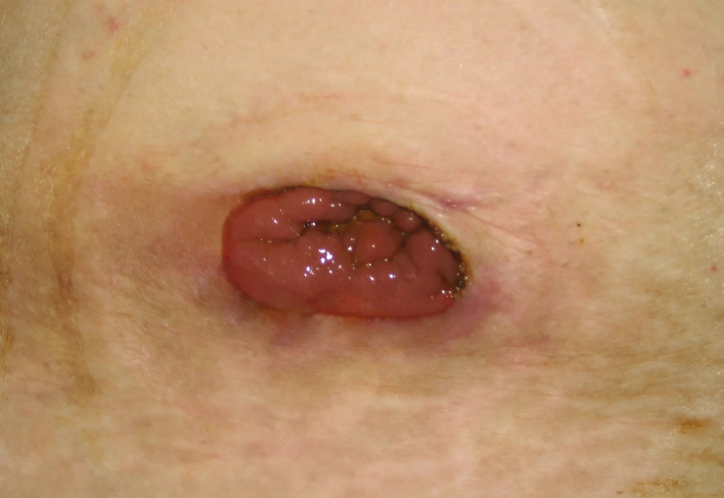 Estoma al ras sin borde: aspectos básicos de la ostomía