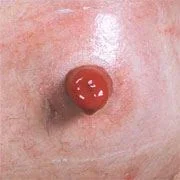 Estoma saliente: aspectos básicos de la ostomía
