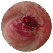 retracted stoma